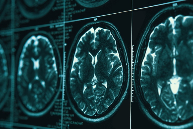 Upoznajmo se sa Parkinsonovom bolešću